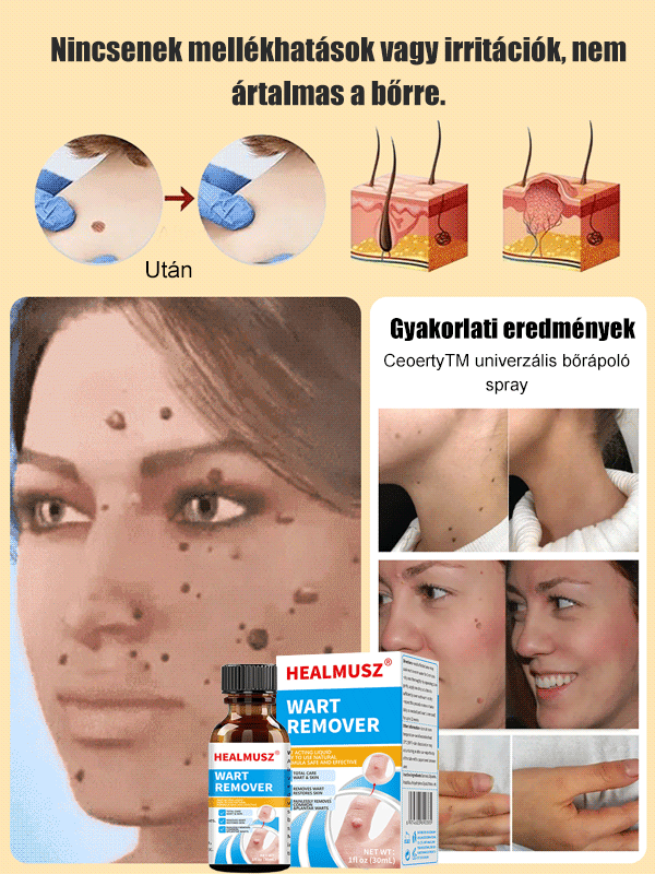 Testápoló szemölcs eltávolító megoldás