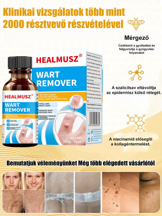 Testápoló szemölcs eltávolító megoldás